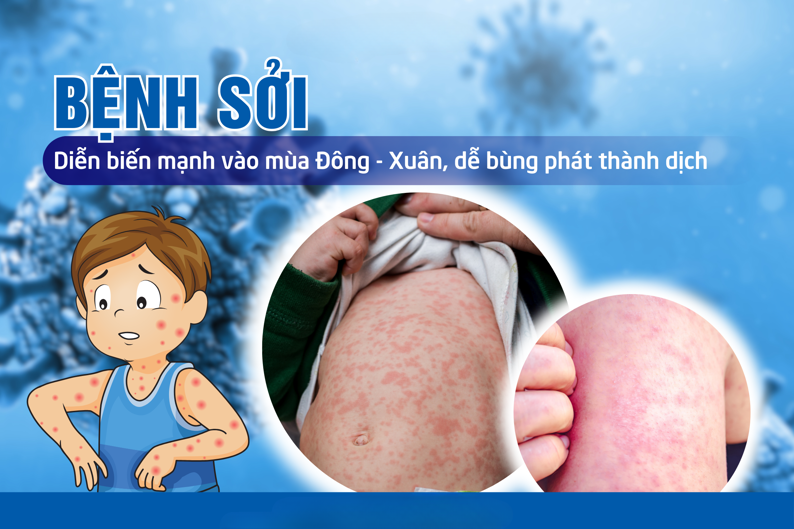 Tổng quan về bệnh sởi